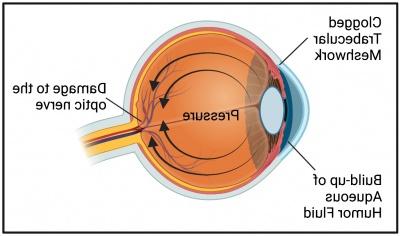 exfoliation glaucoma image
