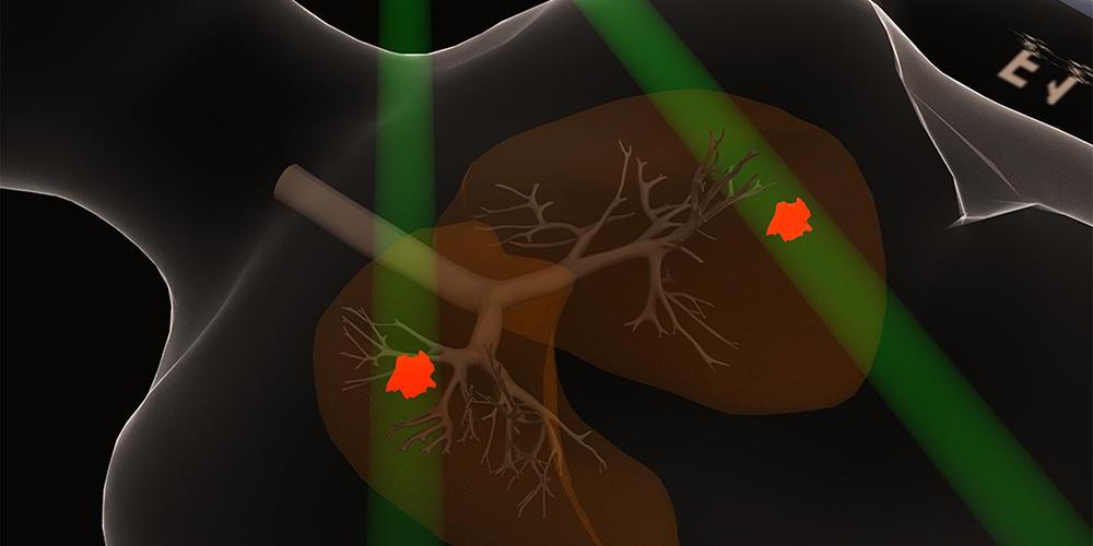 小细胞肺癌扫描图